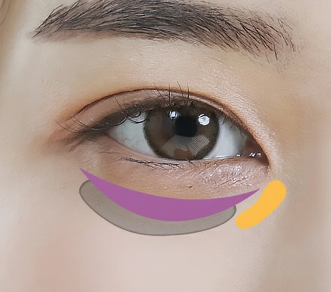 شد الجفن السفلي