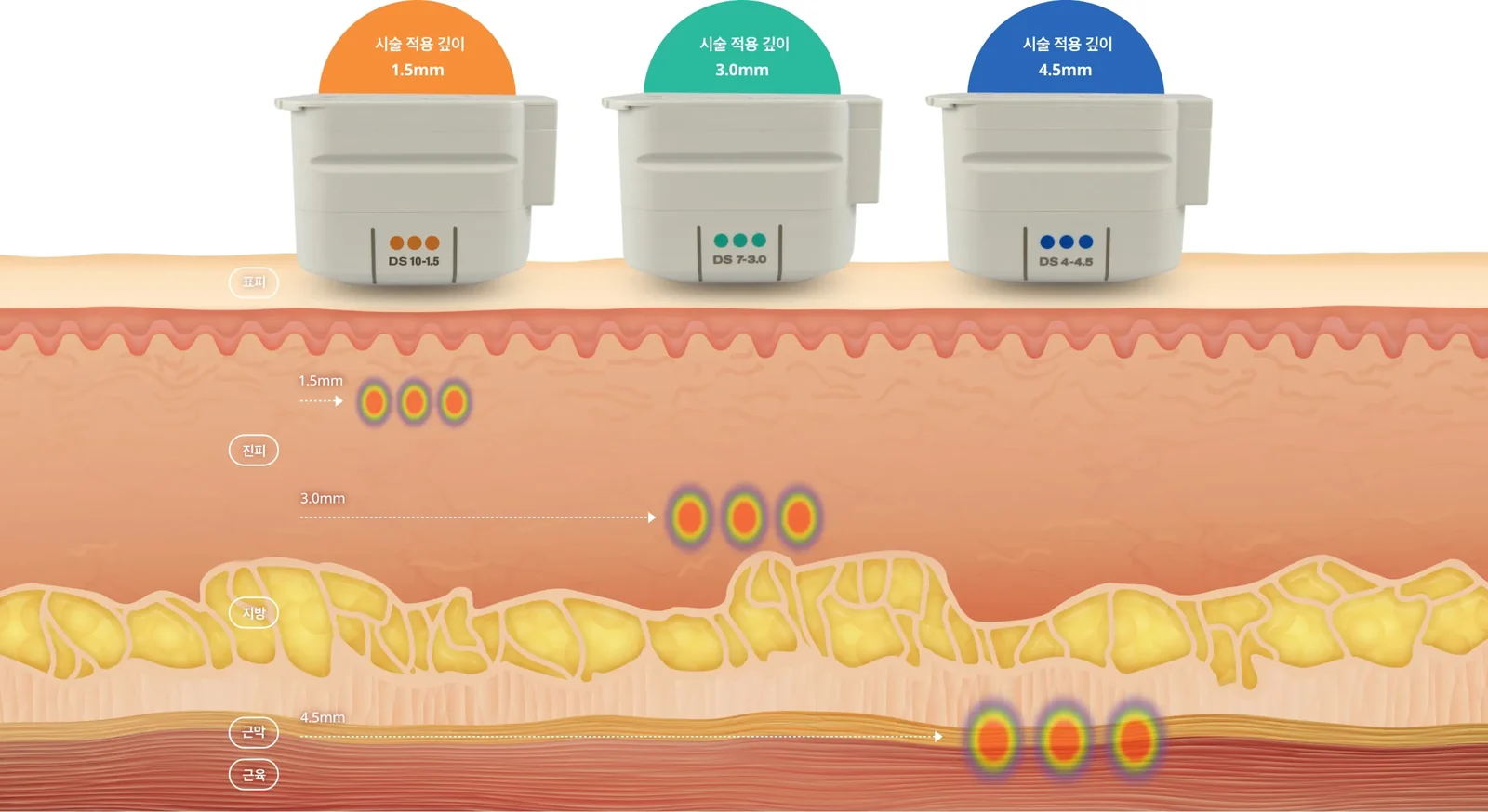 استهداف الأعماق في أولثيرا (Ultherapy) برايم: 1.5 مم و3.0 مم و4.5 مم